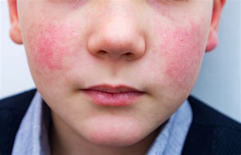 What to Know About Human Parvovirus B19 .